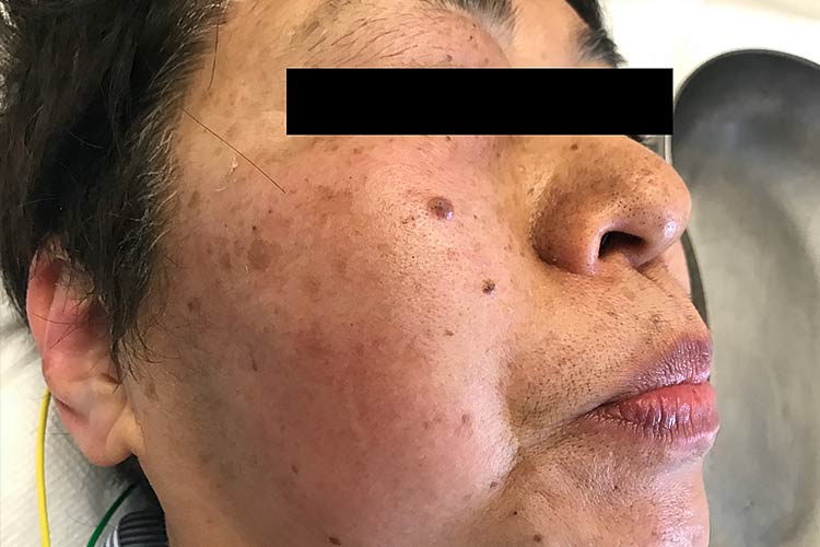 نشانه های سندروم سروتونین